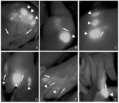 Inflow Occlusion Combined With Bleomycin Sclerotherapy for Management of Macro/Mixed Cystic Lymphatic Malformation in Children